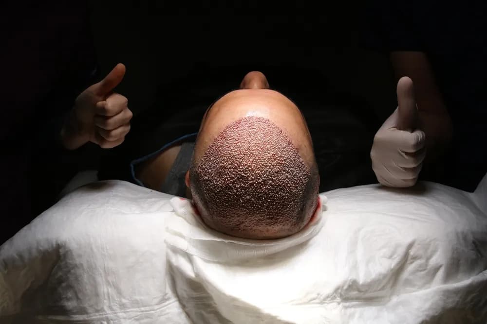 Hair Transplant (FUE, DHI, Sapphire FUE)