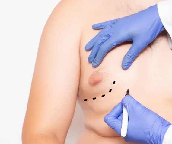 Gynecomastia Treatment (Male Breast Reduction)